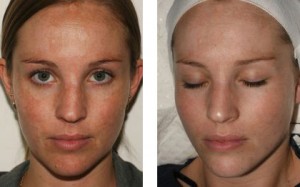 remove unsightly brown spots